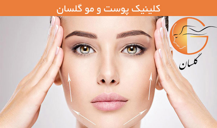 لیفت نخ در رشت
